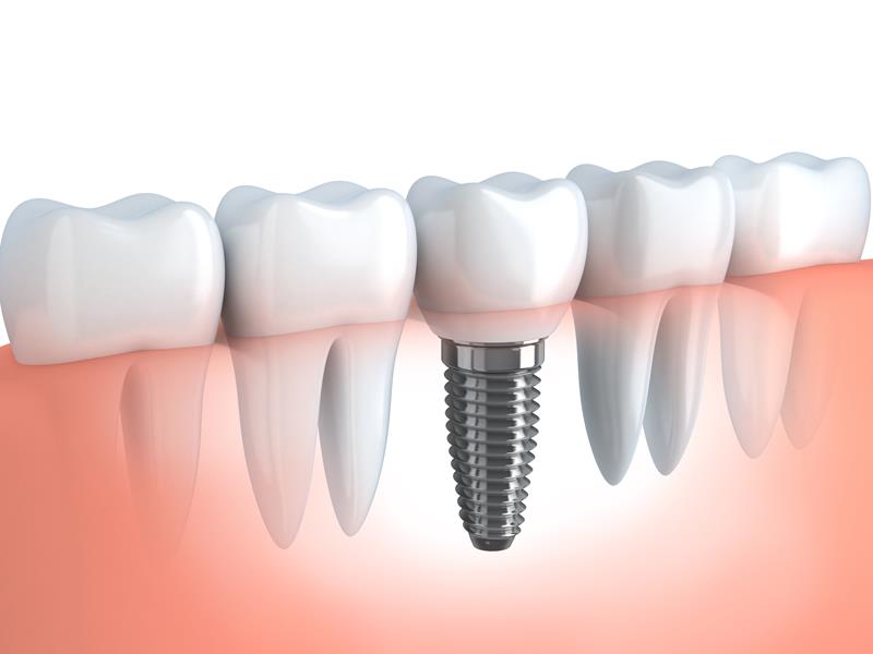 Dental Implants  Raleigh, NC 